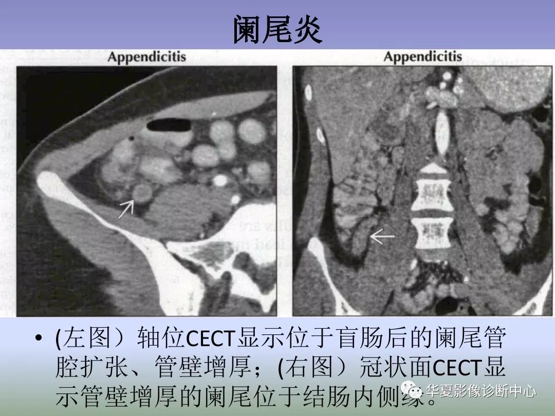 回盲部占位或炎症的影像鉴别诊断