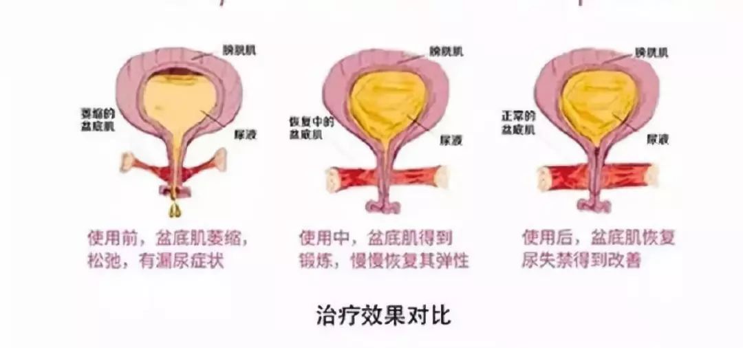 您想知道的盆底肌康复图解详解