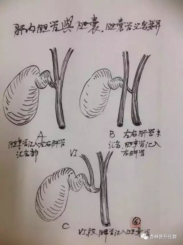 同学们,预习时间到了,专业手绘胆囊解剖,美不美?