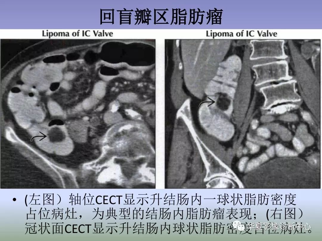 回盲部占位或炎症的影像鉴别诊断