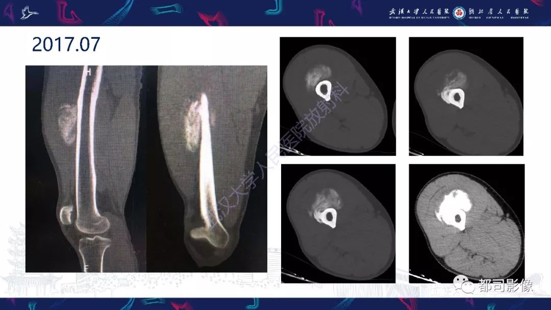 骨旁骨肉瘤影像诊断