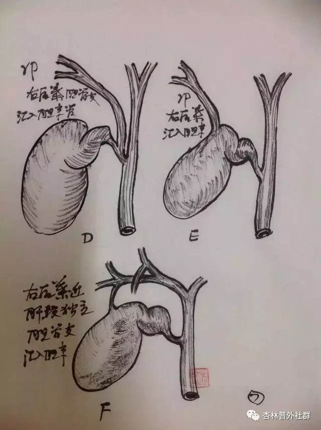 同学们,预习时间到了,专业手绘胆囊解剖,美不美?