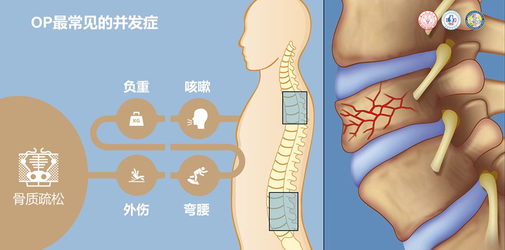 10月健康讲座:中老年骨质疏松性骨折的危害与预防