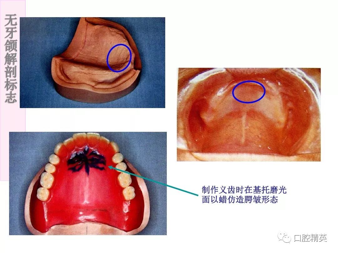 无牙颌解剖标志