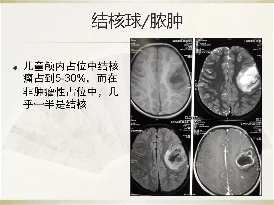 脑结核的mr表现