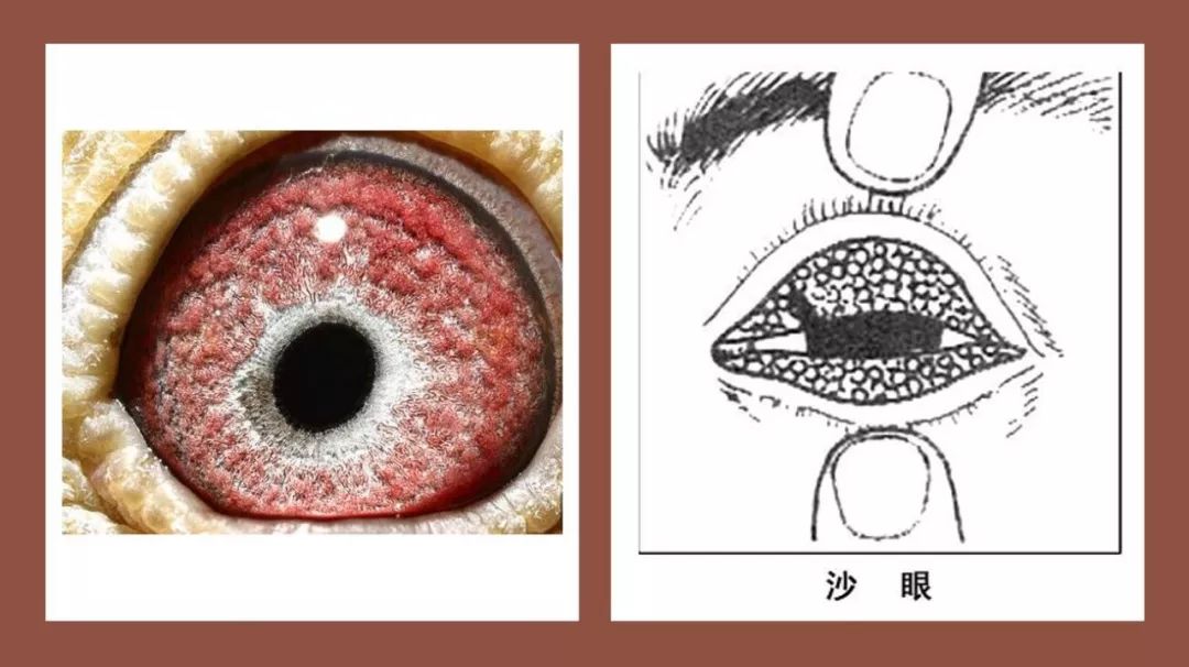 沙眼会传染 注意有五个特征