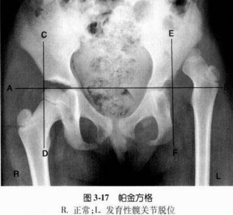 帕金(perkin)方格为髂骨外缘与股骨颈外缘的光滑