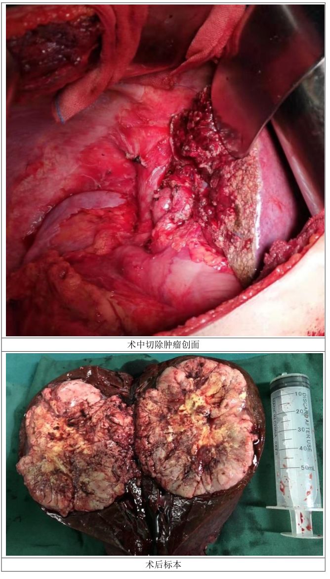【医疗技术】向肝脏巨大肿瘤发出新的挑战_手术