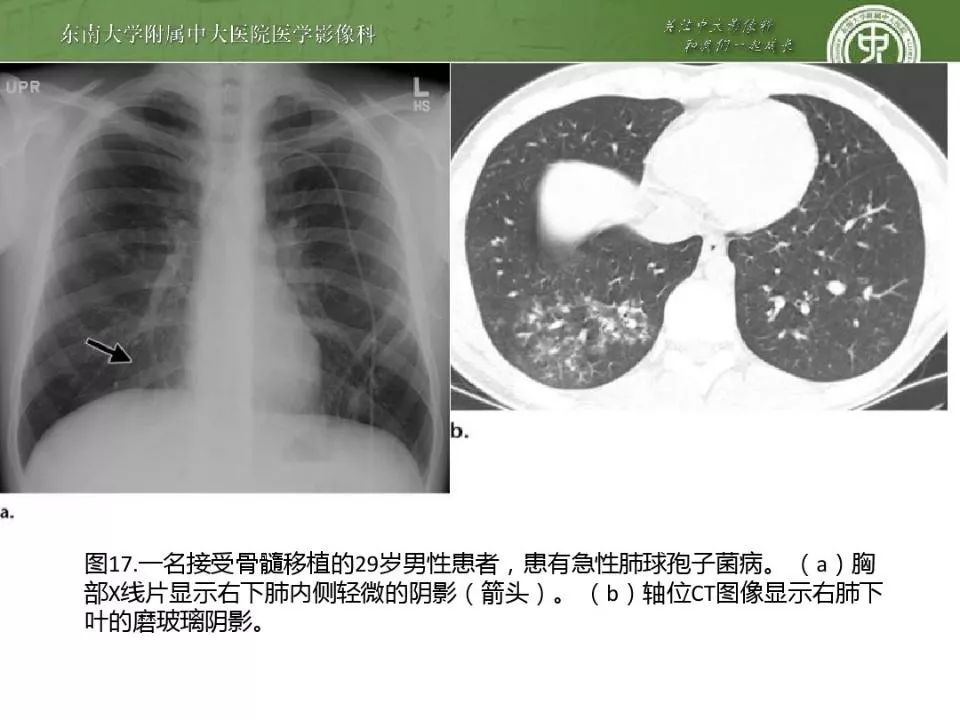 肺球孢子菌病胸片与ct影像的图解综述