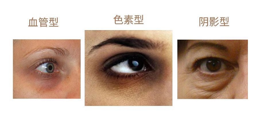 管你哪个类型的黑眼圈,学会这几点,统统滚蛋!