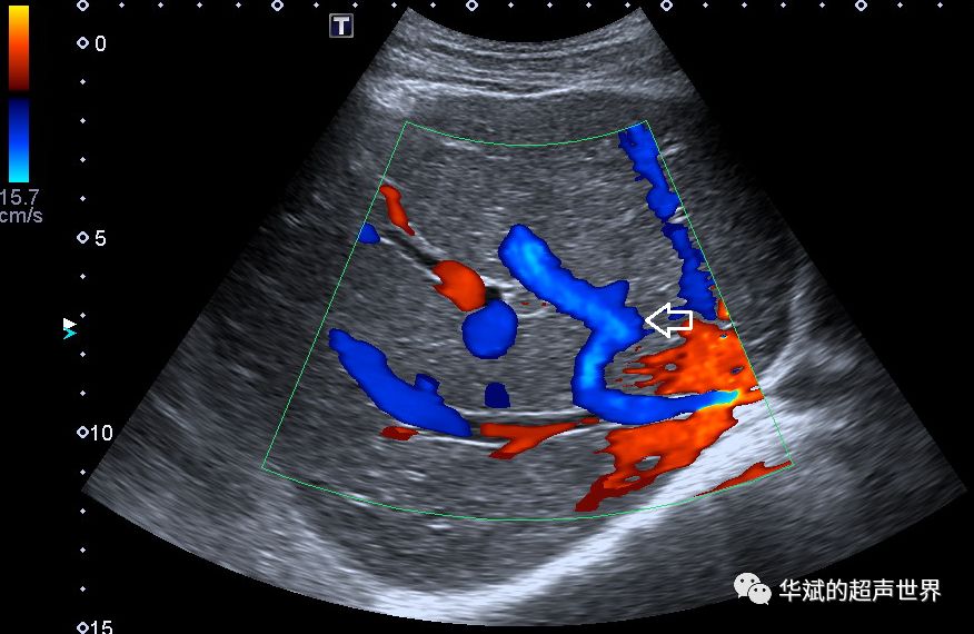 肝脏超声:直角血管征_静脉