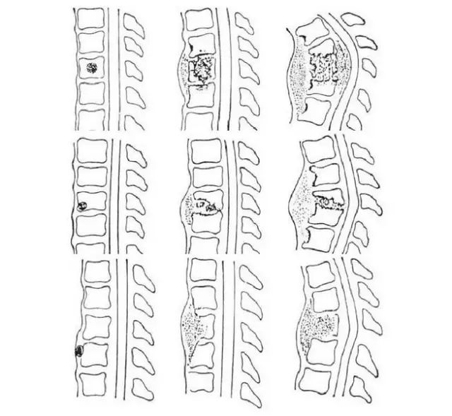 2,边缘型(椎间型):椎体对应的边缘皮质模糊,破坏,椎间隙狭窄.