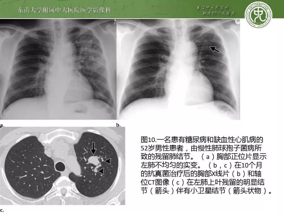 肺球孢子菌病:胸片与ct影像的图解综述