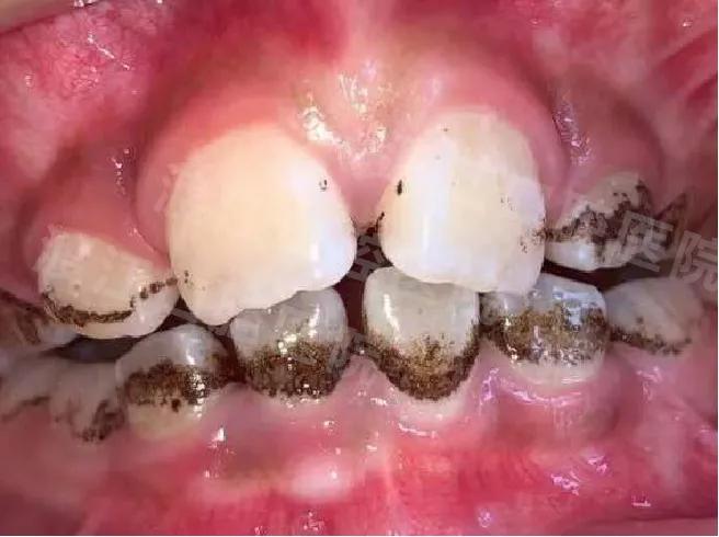 渡江口腔优秀病例展示儿童牙齿黑斑不齐