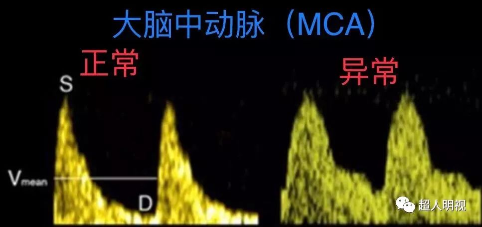 这是好孩子——再谈大脑中动脉舒张期缺如_胎儿