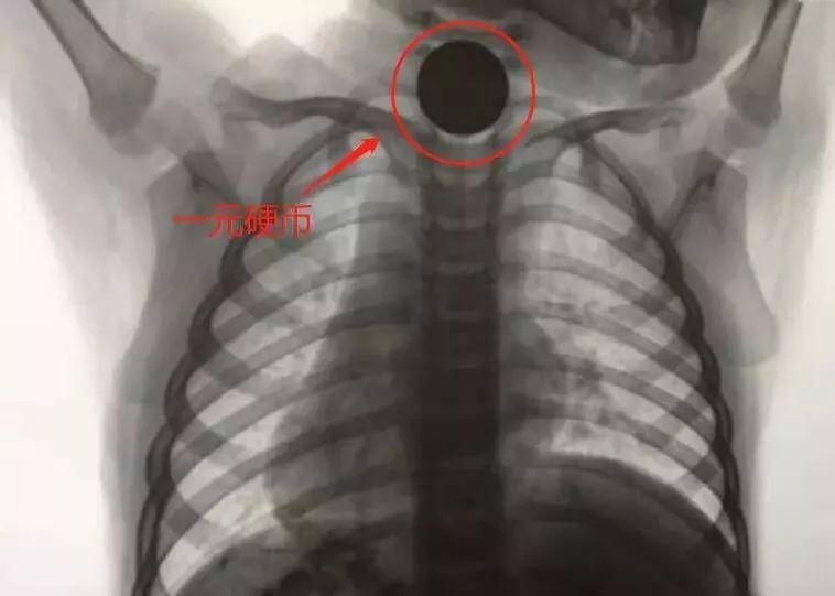 半岛晨报：旅顺三岁男童就医时烦躁哭闹，医生从其食管中取出…