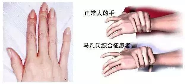 25岁女孩患罕见蜘蛛指病生命垂危