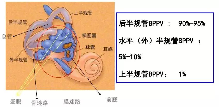 3 耳石症-临床类型 根据迷路结石的存在部位分为上半规管型,后半规管