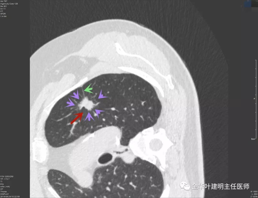 经验积累太难了这样的肺结节到底是良性还是恶性