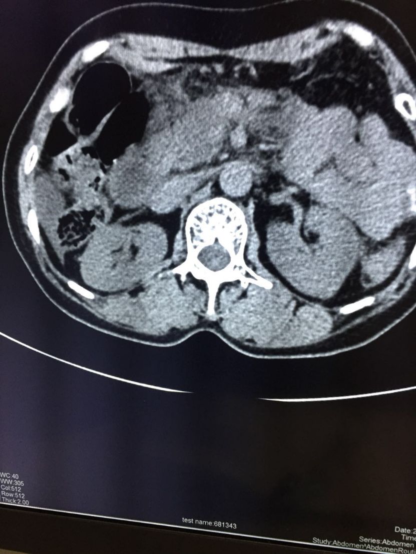 "我就得个胰腺炎,为啥ct平扫后还加做增强扫描?