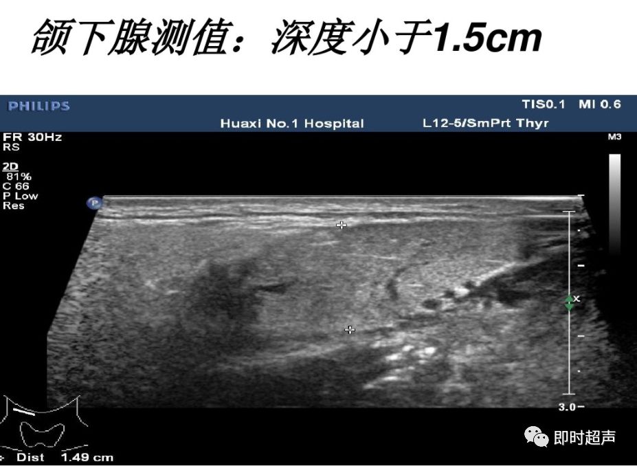 颌下腺解剖及正常超声表现