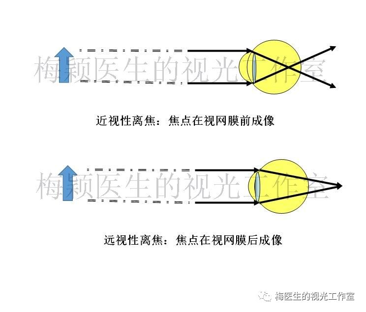 假性近视形成近视性离焦,应该是保护近视的,怎么会促进近视?