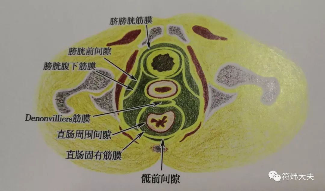 腹侧间隙由膀胱腹下筋膜分为膀胱前间隙和膀胱周围间隙,膀胱前间隙