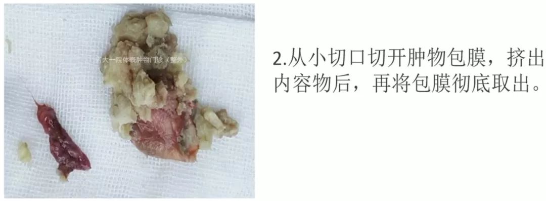 粉瘤(皮脂腺囊肿)需要治疗吗?——体表肿物门诊荣医生