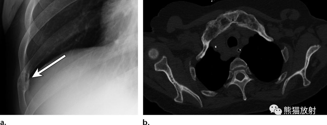 paget病纤维结构不良肋骨良性,恶性病变(类似外伤性肋骨损伤)叉状肋