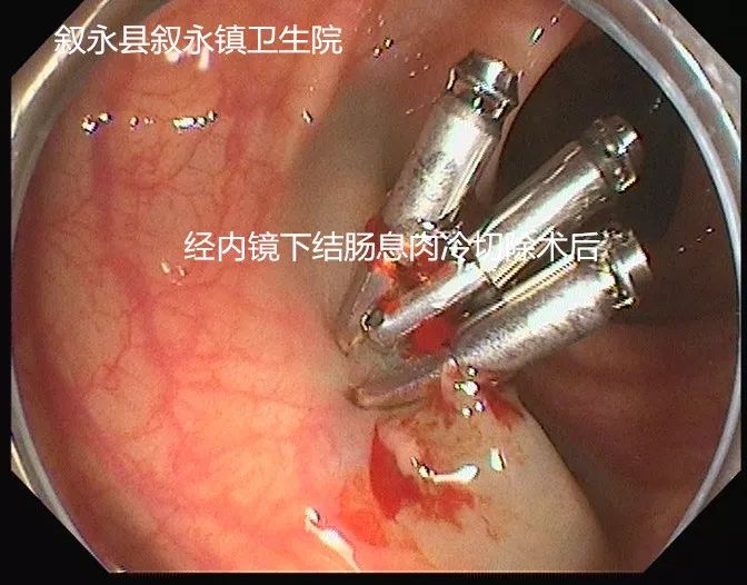 我院在县内率先开展经内镜下结肠息肉冷切除术