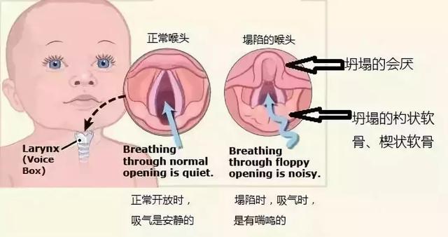 响,不一定是有胎痰,有可能是先天性喉喘鸣