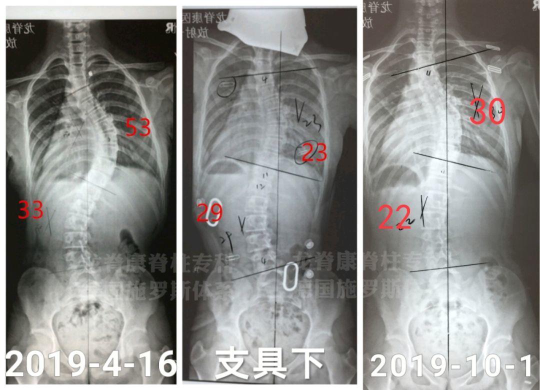 经典问答脊柱侧弯24问很全的问题汇总快收藏