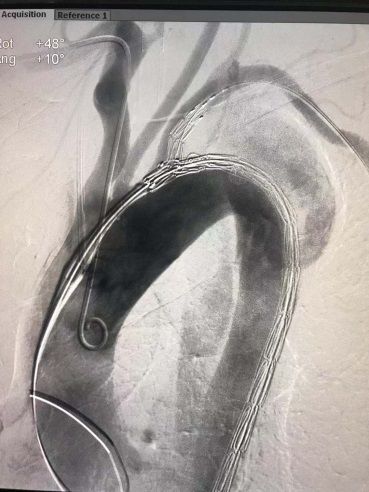 市人民医院血管外科应用castor03分支型覆膜支架治疗主动脉夹层一例