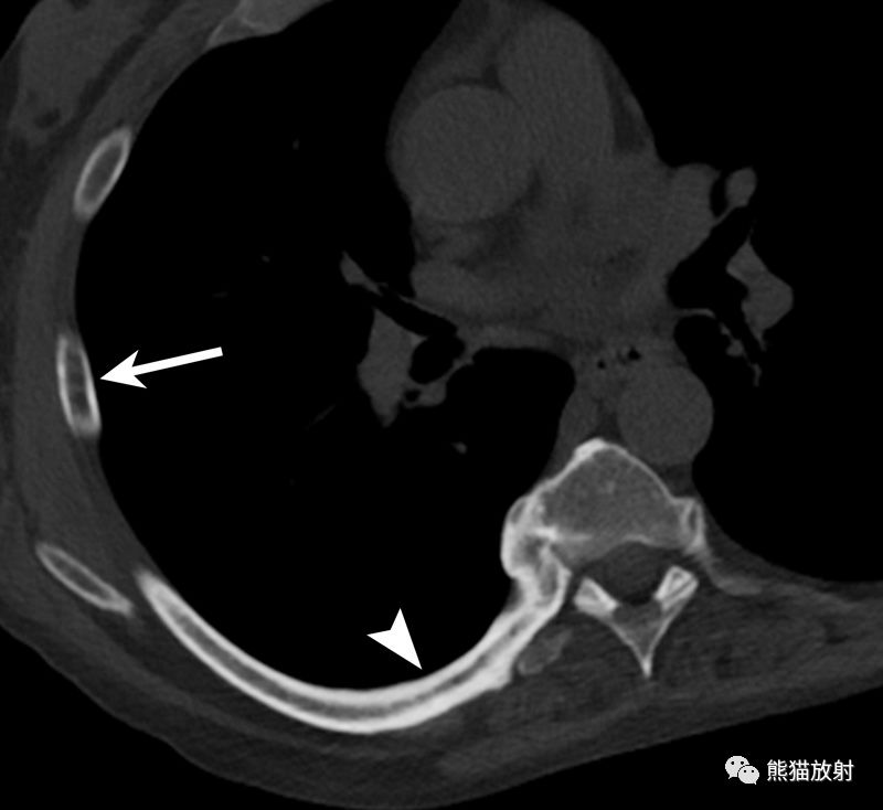 肋骨外伤丨影像表现,并发症