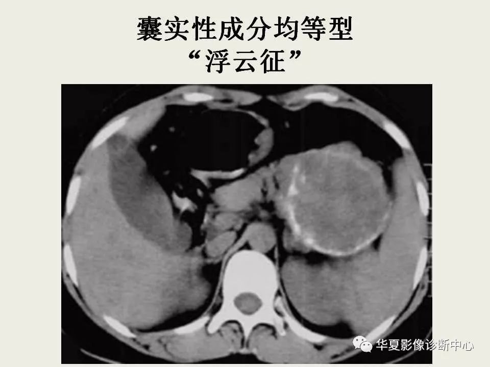影像基础胰腺实性假乳头状瘤影像诊断简述