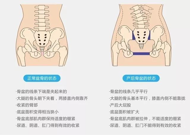 骨盆修复的重要性,妈妈们知道吗?