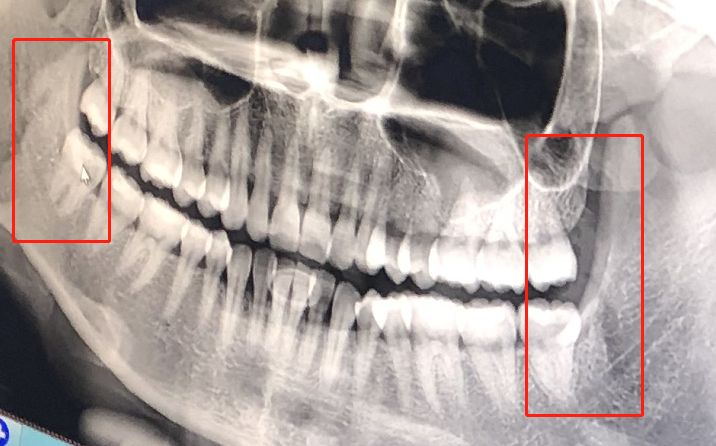 拔牙多少人口_拔牙的疼痛级别是多少