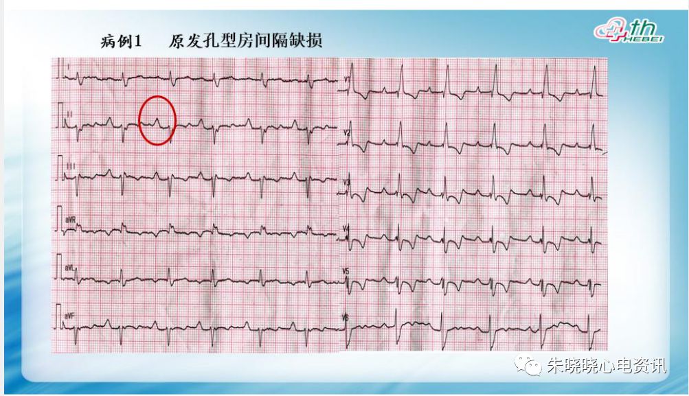 【yy语音】耿旭红老师:先天性心脏病心电图表现 2019