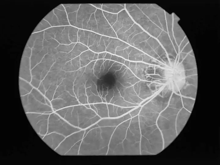 不同眼病的眼底血管荧光造影
