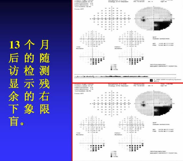 视野检查结果分析基础知识