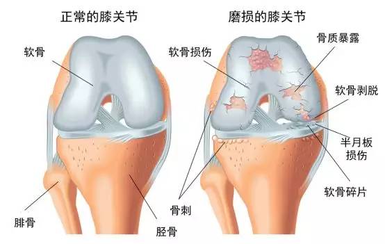 所谓的关节磨损的本质就是软骨磨损,如下图所示,这层软骨由于过度