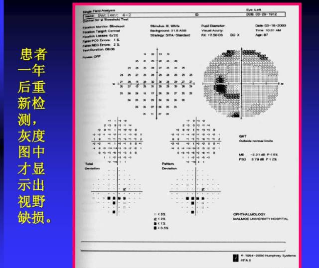 视野检查结果分析基础知识