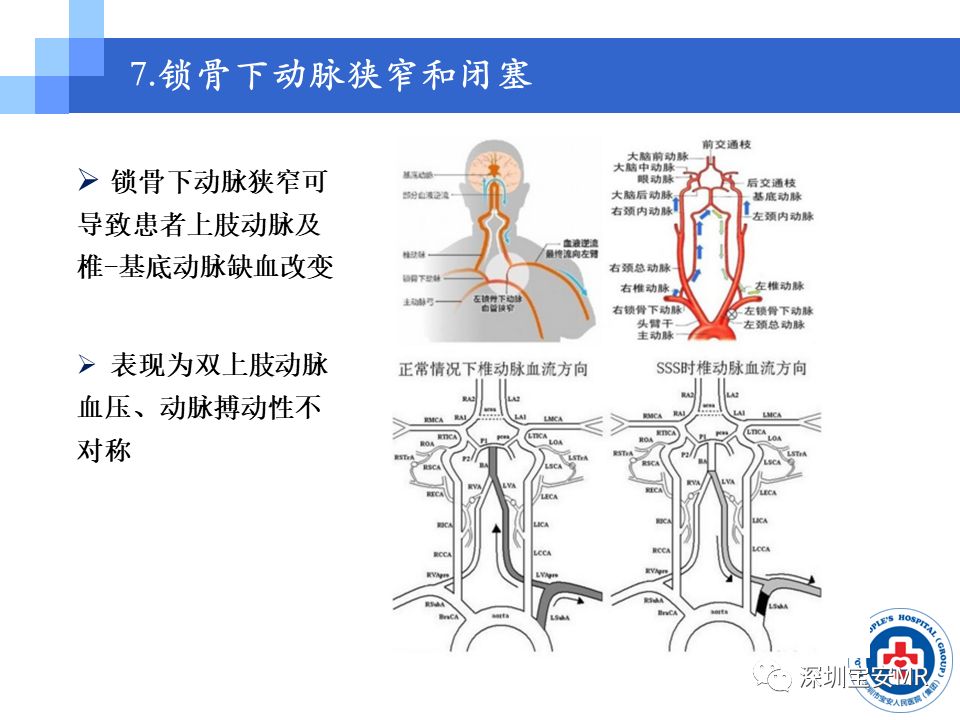 颈动脉超声检查在脑卒中筛查中的应用