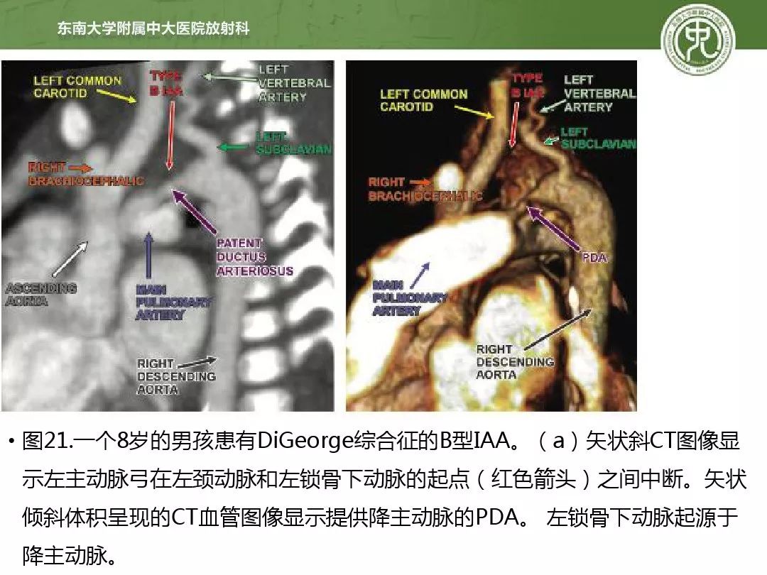 主动脉弓的先天变异和异常的影像学表现