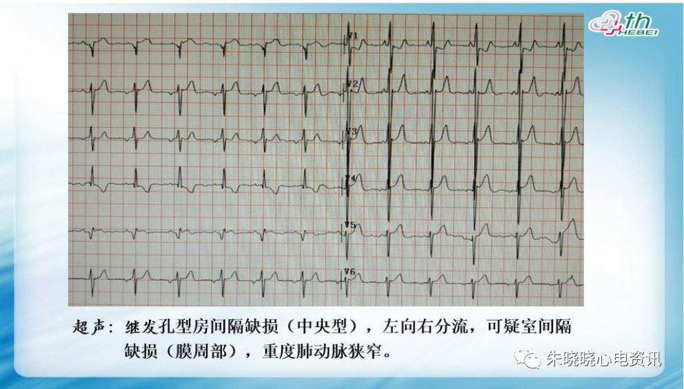 【yy语音】耿旭红老师:先天性心脏病心电图表现 2019