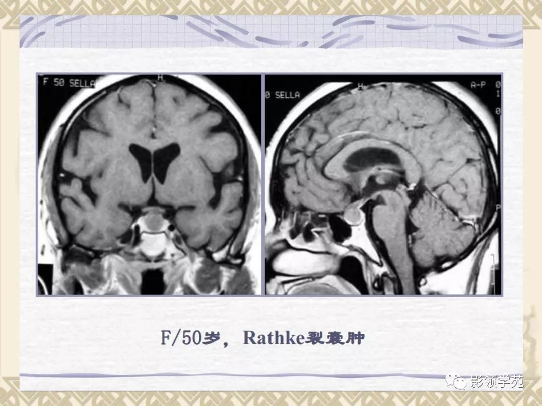 垂体病变的mri诊断