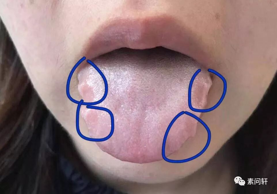 舌头有齿痕是湿气重吗?四种齿痕舌代表你身体出现了不