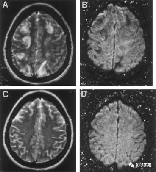 脑白质病变影像诊断