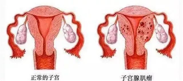 子宫肌瘤专挑3种女人下手！越早艾灸，越早恢复，远离折磨！ .艾灸养生