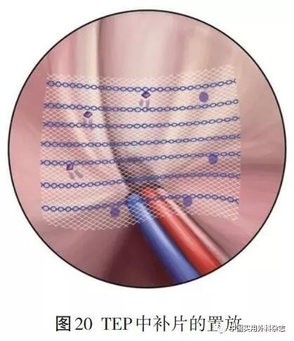核心技术是进入腹腔,分离修补区域的粘连,回纳疝内容物,缝合关闭疝环